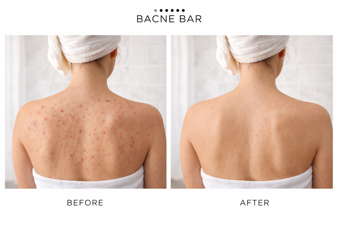 get rid of body acne