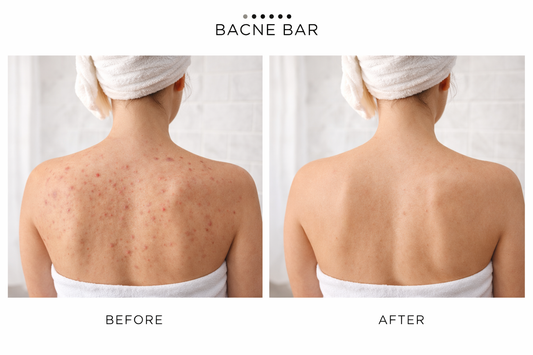 get rid of body acne